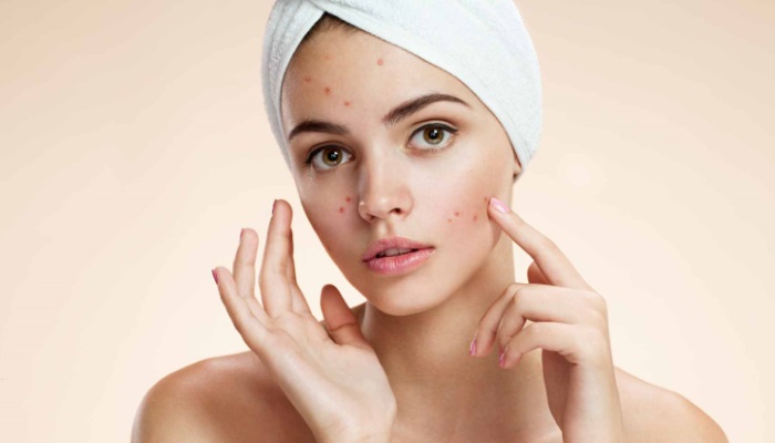 girl seeking acne or pimples treatment over face