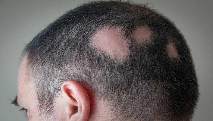 alopecia areata patchy hair loss scalp
