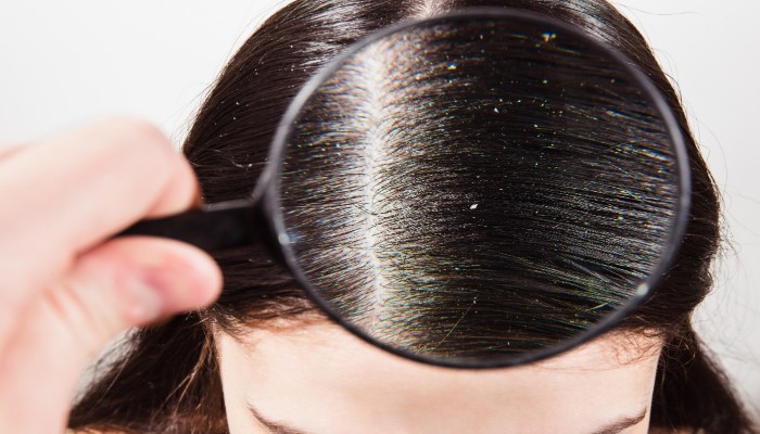 dandruff over scalp