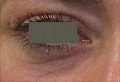 Vascular Type