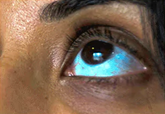 Melanin Skin Hyperpigmentation