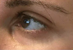 Under eye hollowness