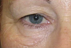 Loose excess skin or Thin skin