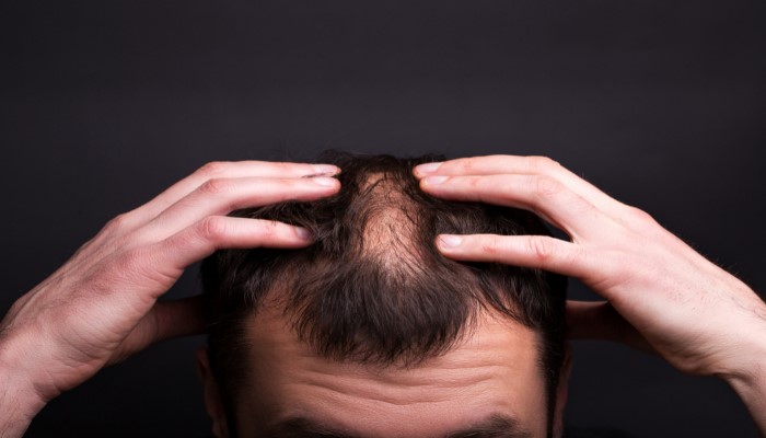 men with bald head androgenic alopecia or male pattern baldness