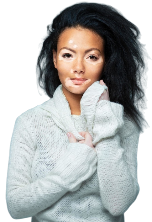 punch grafting treatment surgery for vitiligo in rajkot