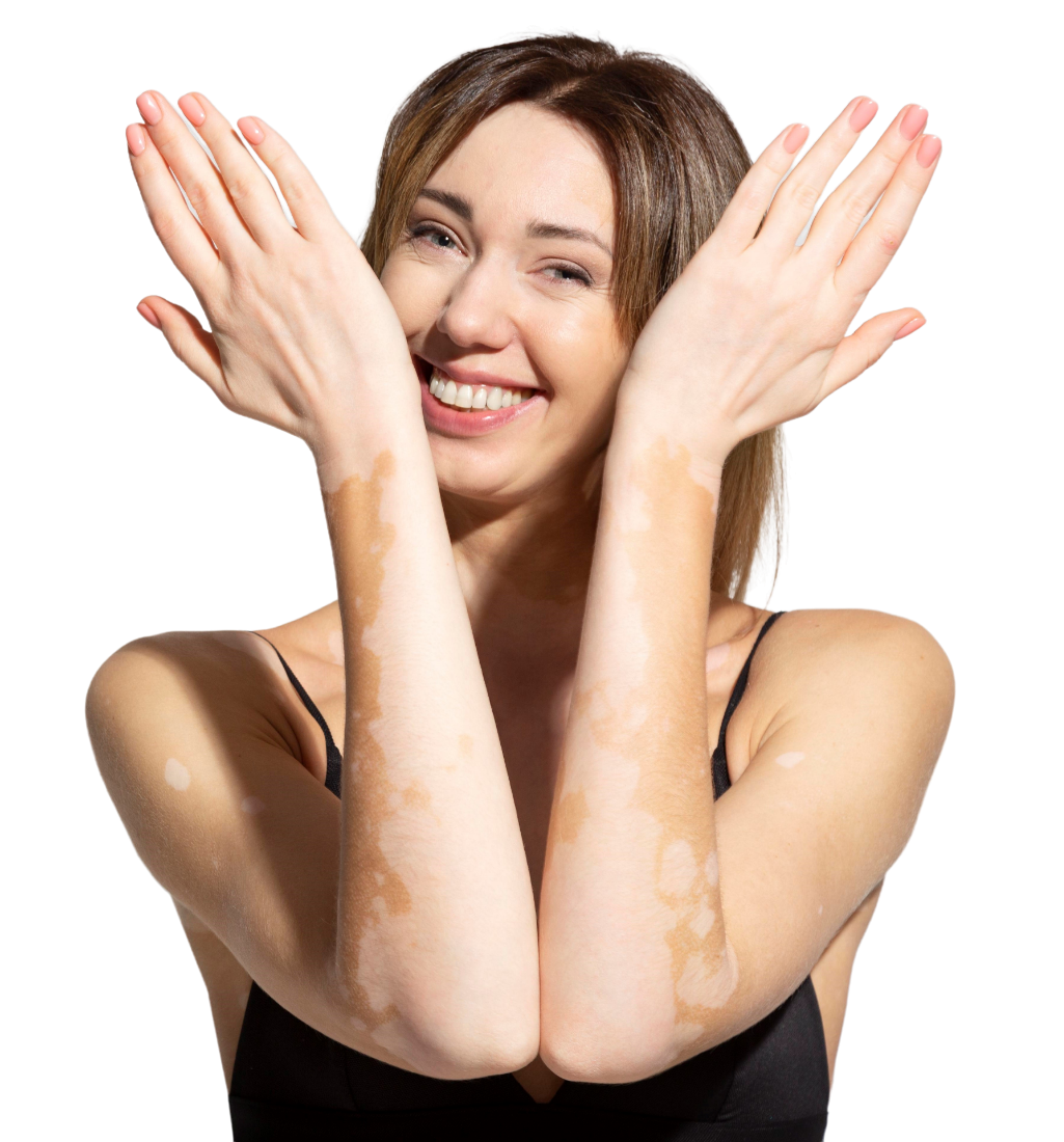 young-woman-with-vitiligo-skin-seeking-treatment-in-rajkot
