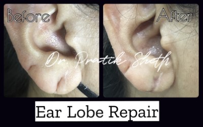 Ear Hole Repair  Best Ear Lobe Repair Specialist in Pune - Dr