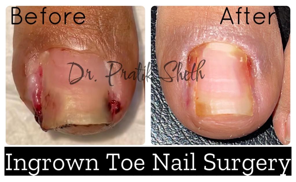 My FootDr - What's our trick to permanently correcting ingrown toenails? A  PNA (partial nail avulsion) procedure. It removes the small piece of  ingrowing nail, and then destroys the nail growing cells