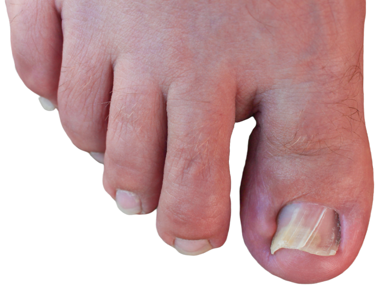 Ingrown Toenail Surgery, Removal & Treatment | Walk Without Pain