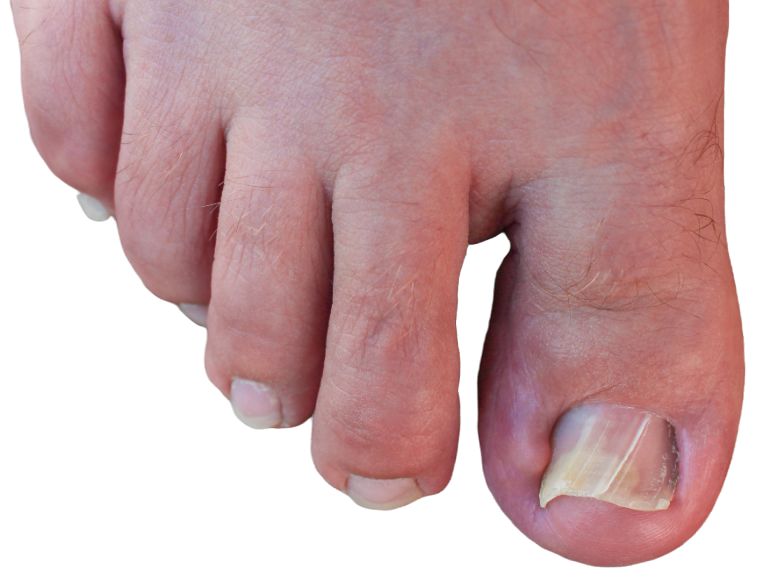 ingrown toe nail or nail growing in surrounding skin