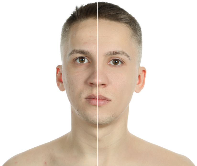chemical peeling for men for pigmentation or dark spots treatment over face