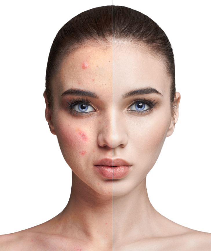 face of woman with acne pimples showing before after effects of chemical peeling