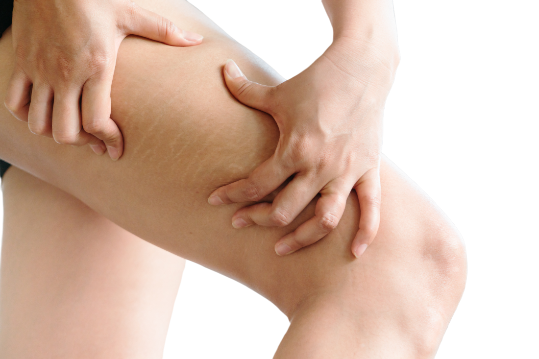 Stretch marks over thighs