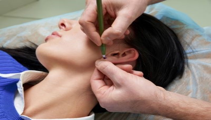 dermatologist in rajkot marking for ear lobe repair