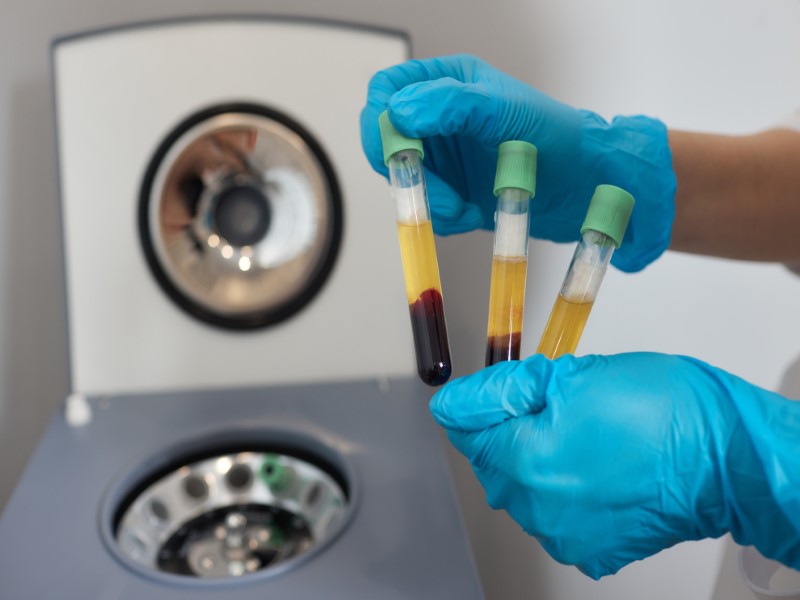 centrifugation of blood to seperate platelets or growth factors