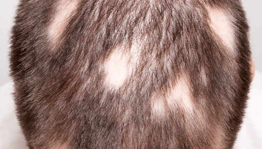 Alopecia Areata