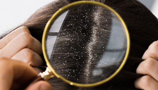 Dandruff