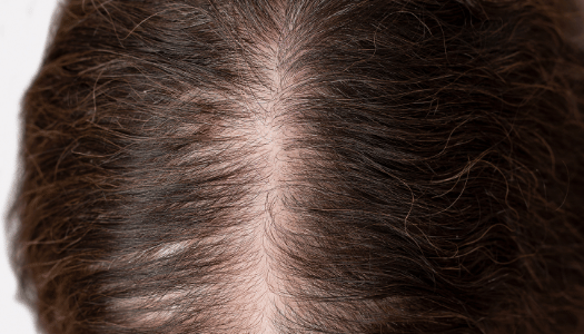 Female Pattern Hair Loss