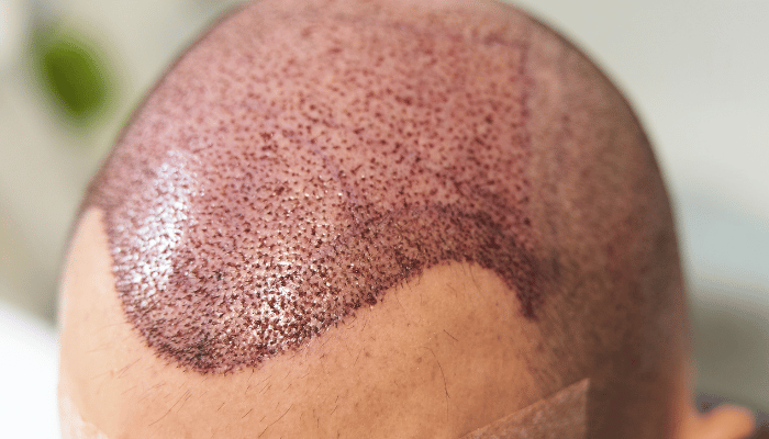 Hair Transplant (FUE)