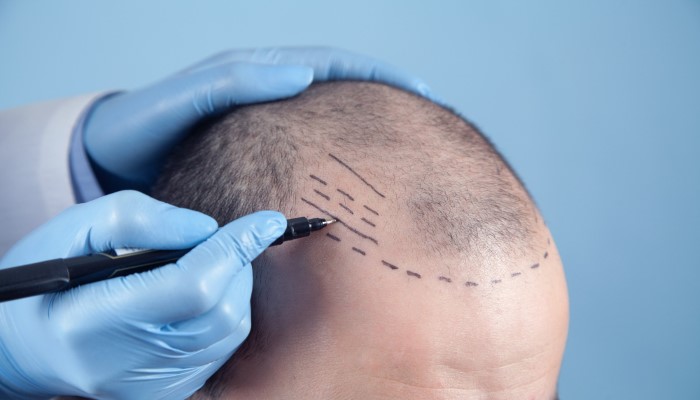 dermatologist in rajkot doing markings for fue hair transplant