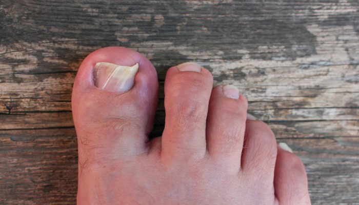 painful ingrown toe nail