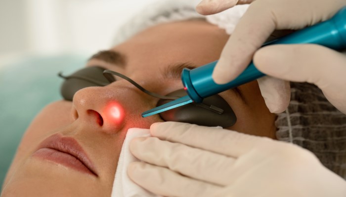 dermatologist in rajkot performing laser mole removal