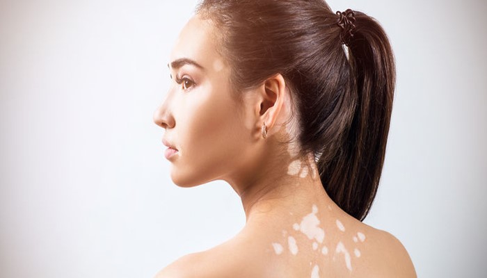 girl having vitiligo or white patches over face and back