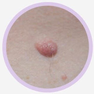 Intradermal Nevus