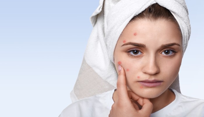 Post Acne Dark Spots