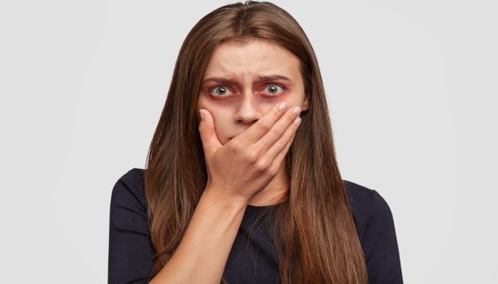 Dark Circles Under the Eyes