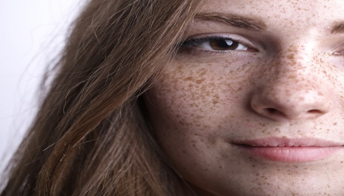 Freckles