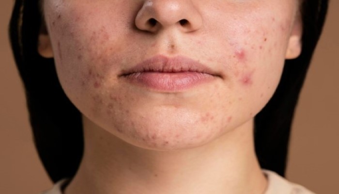 Post Acne Dark Spots