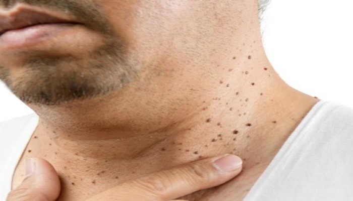 skin tags achrochordons over face and neck